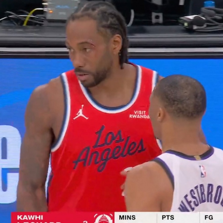 小卡眼角被打破血流不止 回更衣室治疗之后已经重回球场